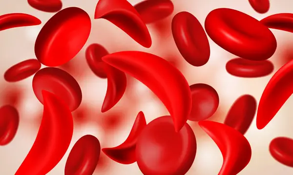 Penyempitan Pembuluh Jantung